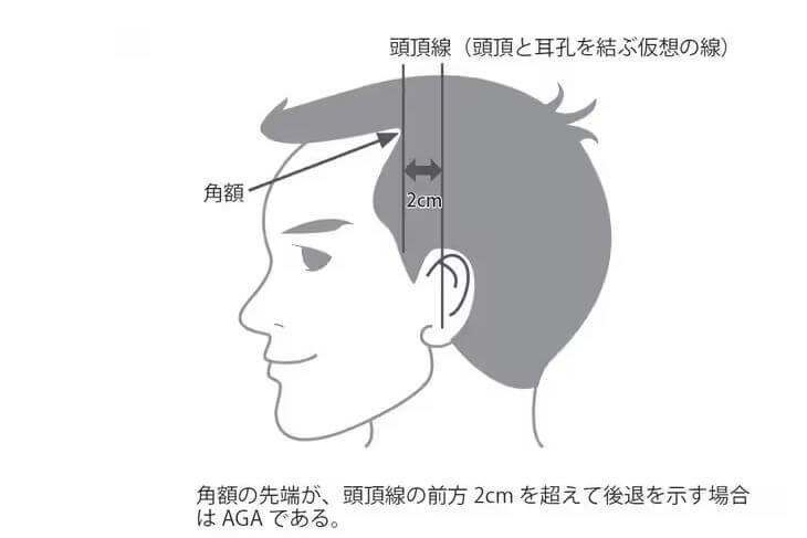 AGA診断